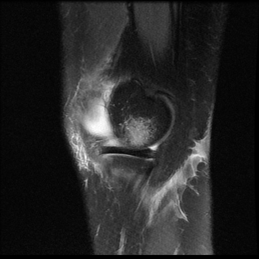 File:Bucket handle meniscus tear (Radiopaedia 56916-63751 Sagittal PD fat sat 17).jpg