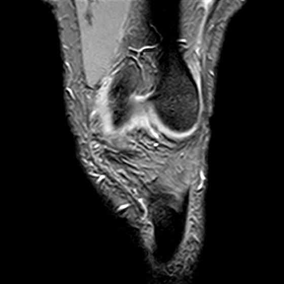 File:Bucket handle tear - medial meniscus (Radiopaedia 29250-29664 B 2).jpg