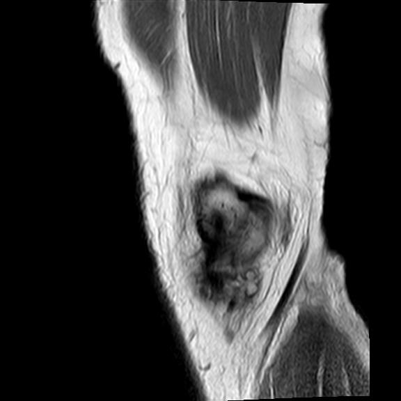 File:Bucket handle tear - medial meniscus (Radiopaedia 29250-29664 Sagittal PD 21).jpg