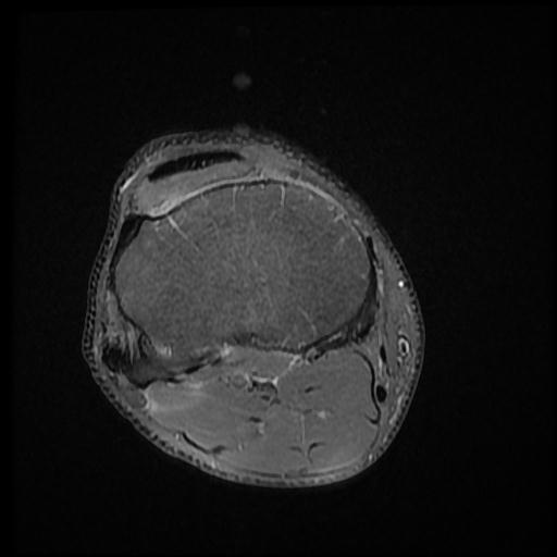 File:Bucket handle tear - medial meniscus (Radiopaedia 69245-79026 Axial PD fat sat 16).jpg