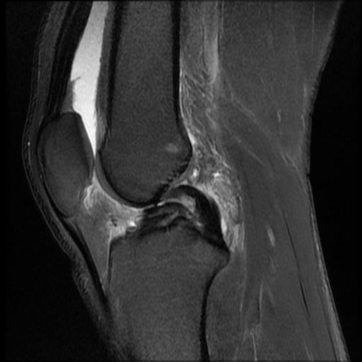 File:Bucket handle tear - medial meniscus (Radiopaedia 69245-79026 Sagittal PD fat sat 9).jpg