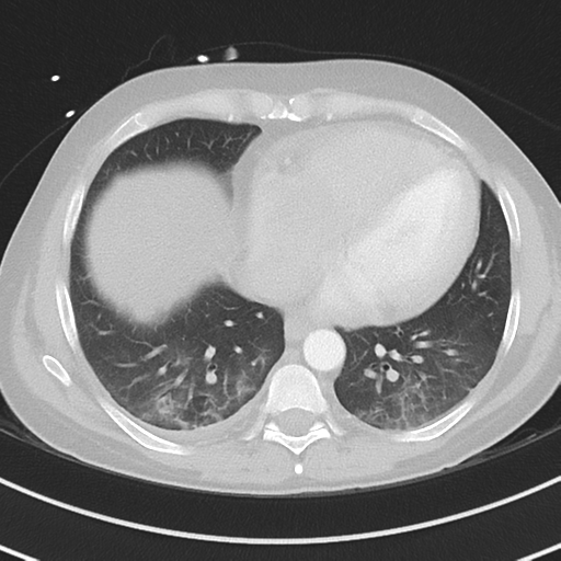 Burkitt lymphoma (Radiopaedia 34686-36121 Axial lung window 34).png