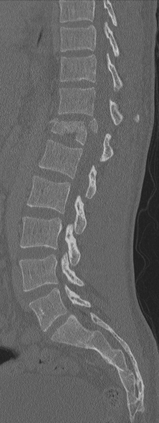 Burst fracture - T12 with conus compression (Radiopaedia 56825-63647 Sagittal bone window 37).png