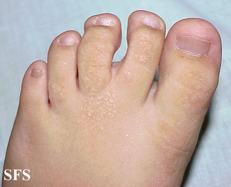Buschke-Ollendorf Syndrome (Dermatology Atlas 10).jpg