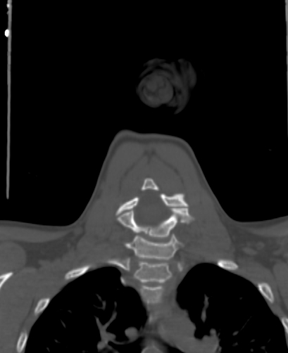 Butterfly vertebra (Radiopaedia 77903-90209 Coronal bone window 44).jpg