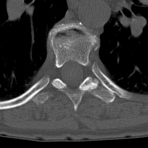 Butterfly vertebrae with kyphoscoliosis (Radiopaedia 14257-14133 Axial bone window 11).jpg