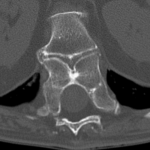 Butterfly vertebrae with kyphoscoliosis (Radiopaedia 14257-14133 Axial bone window 54).jpg