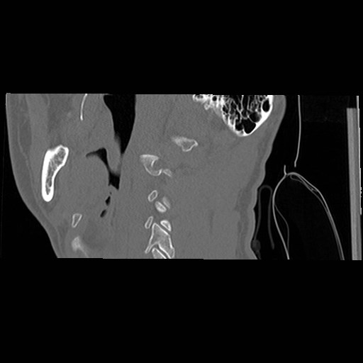 File:C1-C2 "subluxation" - normal cervical anatomy at maximum head rotation (Radiopaedia 42483-45607 C 56).jpg