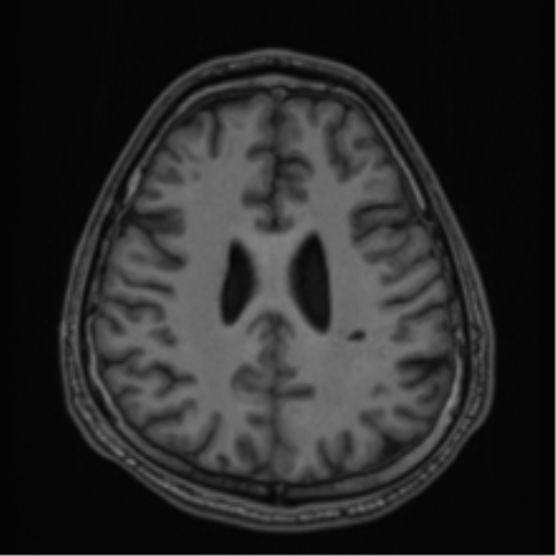 CNS vasculitis (Radiopaedia 55715-62263 Axial T1 59).png