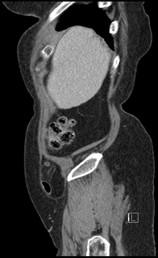 Calcified adrenal glands and Spigelian hernia (Radiopaedia 49741-54988 C 143).jpg