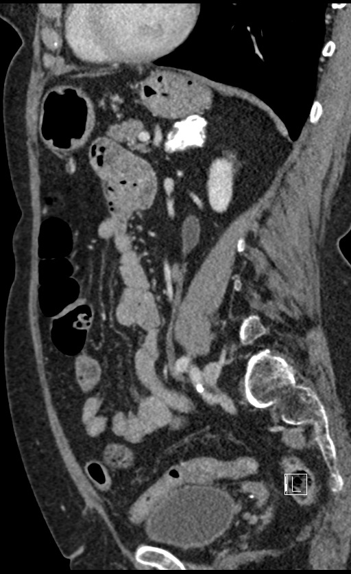 Calcified adrenal glands and Spigelian hernia (Radiopaedia 49741-54988 C 61).jpg