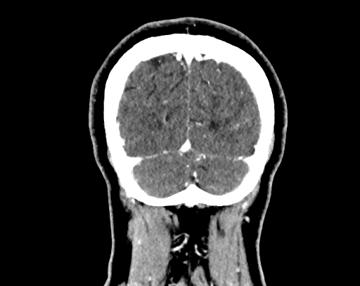 File:Calcified cerebral hydatid cyst (Radiopaedia 65603-74717 C 66).jpg