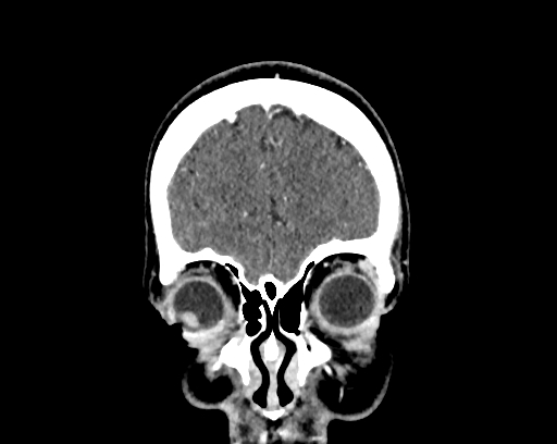 Calcified cerebral hydatid cyst (Radiopaedia 65603-74717 C 7).jpg