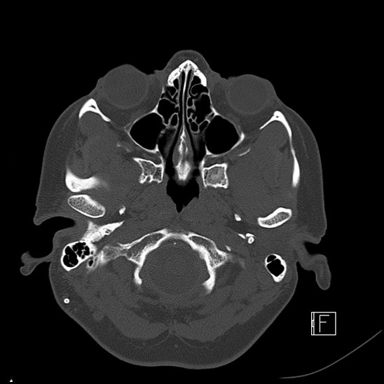Calcified chronic subdural hematoma (Radiopaedia 77374-89492 Axial bone window 12).jpg