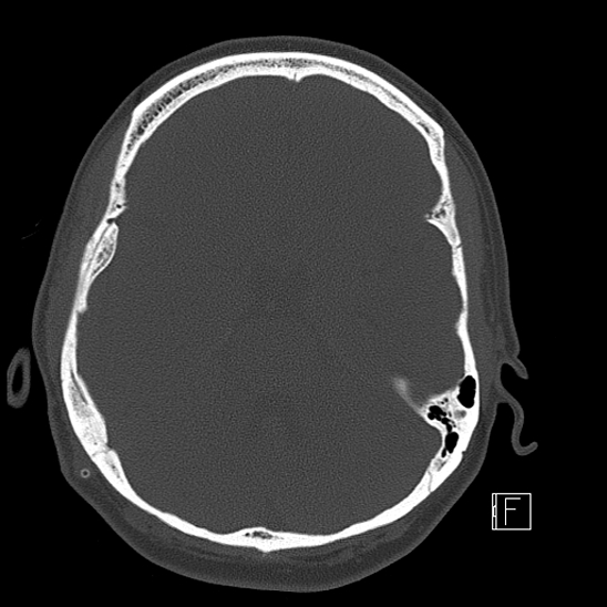 Calcified chronic subdural hematoma (Radiopaedia 77374-89492 Axial bone window 44).jpg
