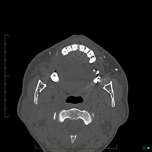 Calcified facial augmentation fillers (Radiopaedia 79514-92679 Axial bone window 93).jpg