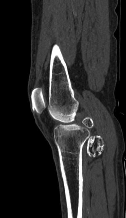 Calcified hematoma - popliteal fossa (Radiopaedia 63938-72763 Sagittal bone window 17).jpg
