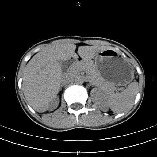 File:Calcified hepatic hydatid cyst (Radiopaedia 83870-99072 Axial non-contrast 53).jpg