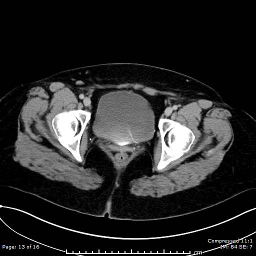 File:Calcified uterine fibroid (Radiopaedia 56077-62759 Axial C+ delayed 13).jpg