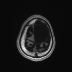 Callosal dysgenesis with interhemispheric cyst (Radiopaedia 53355-59335 Axial T1 141).jpg