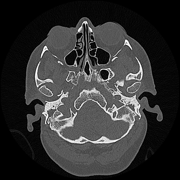 Canal up mastoidectomy (Radiopaedia 78108-90638 Axial bone window 32).jpg