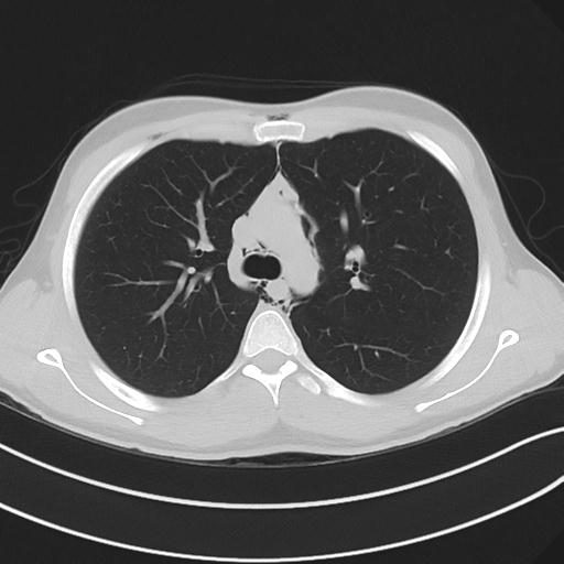 File:Cannabis ('bong') smoking induced pneumomediastinum and subcutaneous emphysema (Radiopaedia 29947-30479 C 35).jpg