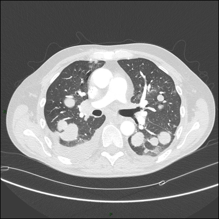 Cannonball metastases (Radiopaedia 82110-96150 Axial lung window 91).jpg