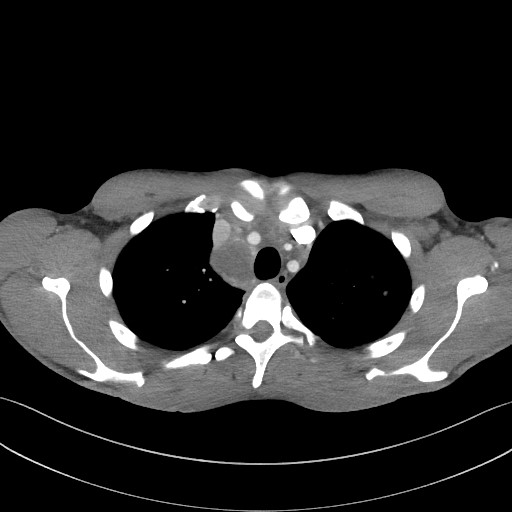 Cannonball metastases - testicular choriocarcinoma (Radiopaedia 84510-99891 B 32).jpg