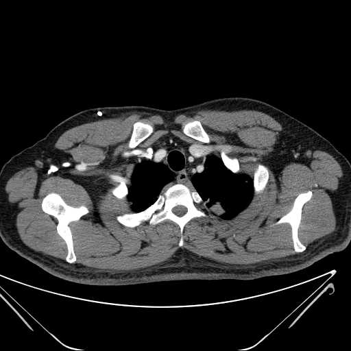 File:Cannonball pulmonary metastases (Radiopaedia 67684-77101 D 32).jpg