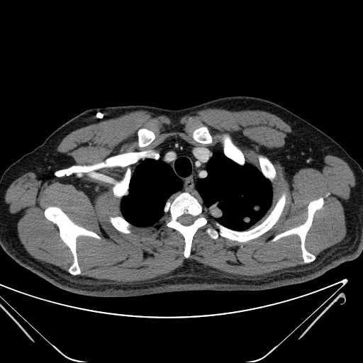 File:Cannonball pulmonary metastases (Radiopaedia 67684-77101 D 39).jpg