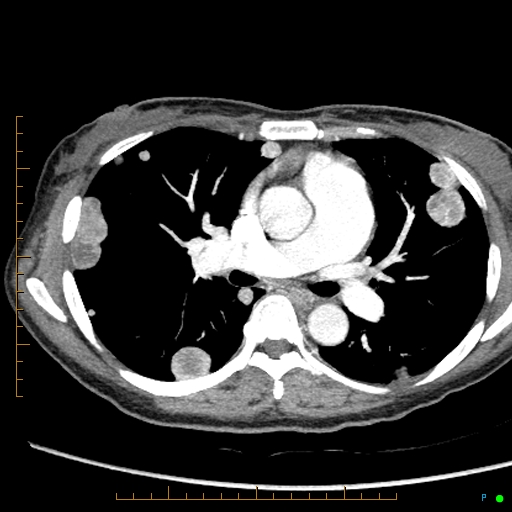 Canonball lung metastasis (Radiopaedia 77634-89837 B 43).jpg
