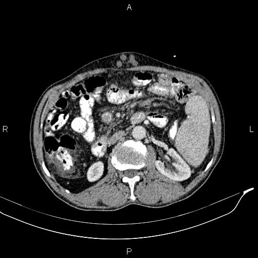 Caput medusae sign - portal hypertension (Radiopaedia 64007-72759 A 39).jpg