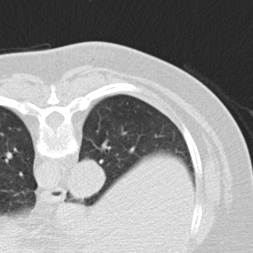 File:Carcinoid tumor - lung (Radiopaedia 44814-48644 Axial lung window 2).png