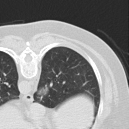 Carcinoid tumor - lung (Radiopaedia 44814-48644 Axial lung window 51).png