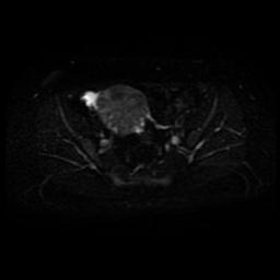 Carcinoma of the cervix (Radiopaedia 89018-105858 Axial DWI 18).jpg