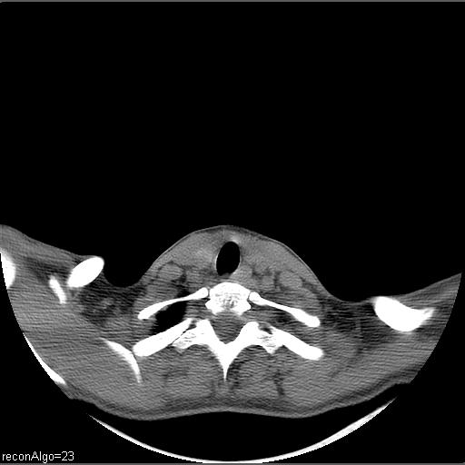 File:Carcinoma of the maxillary antrum (Radiopaedia 53805-59888 Axial non-contrast 10).jpg