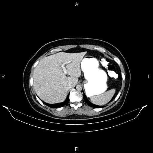 File:Carcinoma of uterine cervix (Radiopaedia 85861-101700 A 33).jpg