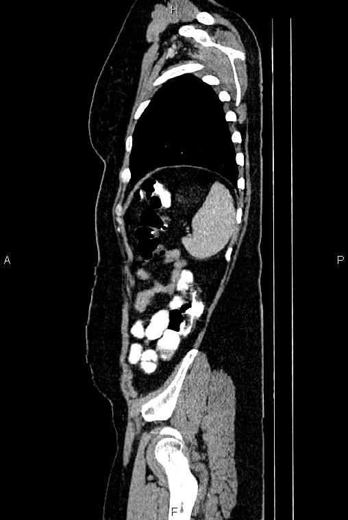 Carcinoma of uterine cervix (Radiopaedia 85861-101700 D 74).jpg