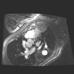 File:Cardiac fibroma (Radiopaedia 38974-41150 4 chamber FGRET 18).jpg