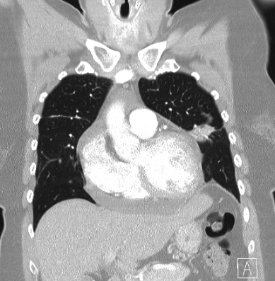 Cardiac sarcoidosis (Radiopaedia 74548-85534 Coronal lung window 20).jpg