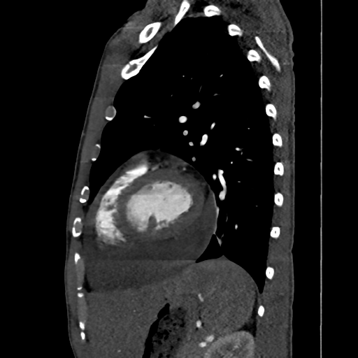 Cardiac tumor - undifferentiated pleomorphic sarcoma (Radiopaedia 45844-50134 B 21).png