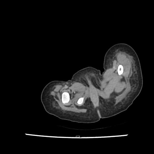 Caroli disease with autosomal recessive polycystic kidney disease (ARPKD) (Radiopaedia 89651-106703 B 247).jpg