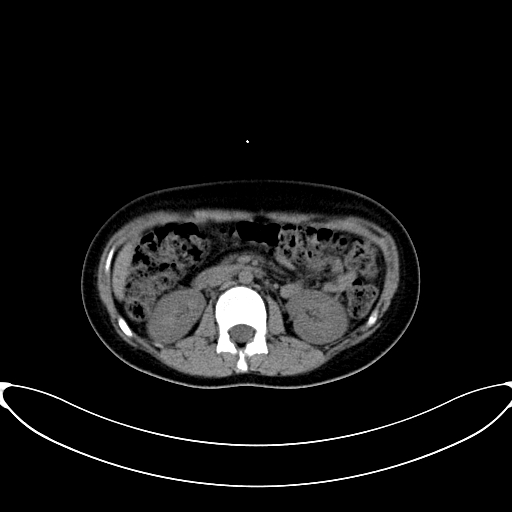 Caroli disease with medullary sponge kidney (Radiopaedia 82622-96804 Axial non-contrast 31).jpg
