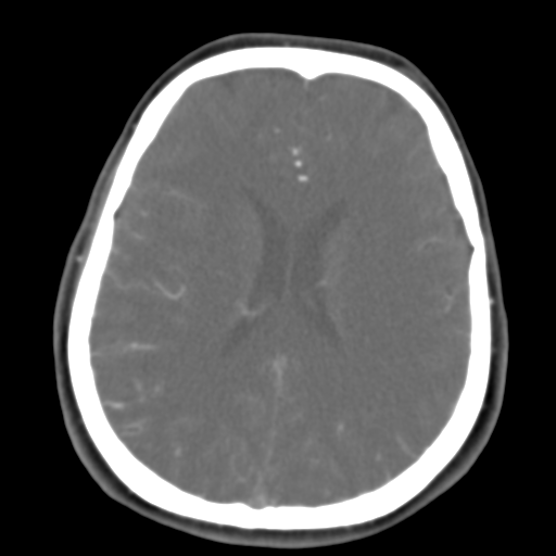 File:Carotico ophthalmic aneurysm (Radiopaedia 42916-46148 A 22).png