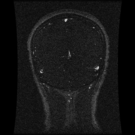 Carotid arterial dissection with acute cerebral infarction (Radiopaedia 26636-26784 MRV 61).jpg