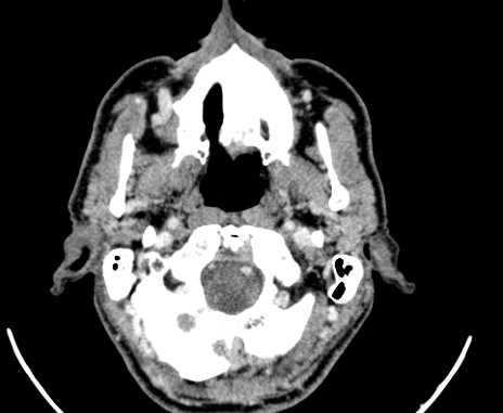 Carotid body tumor (Radiopaedia 61750-69757 Axial Post contrast 4).jpg