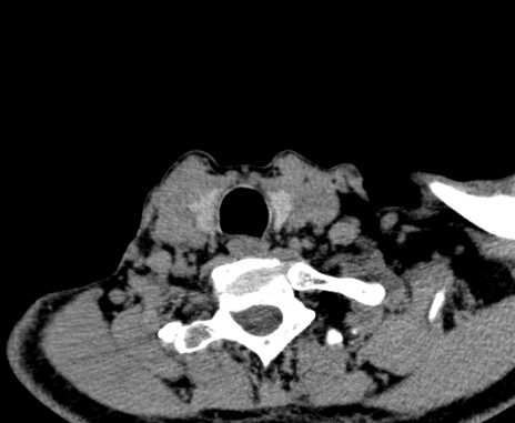 File:Carotid body tumor (Radiopaedia 61750-69757 Axial non-contrast 98).jpg