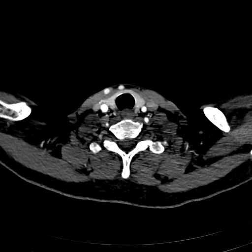 Carotid body tumor (Radiopaedia 83615-98727 A 95).jpg