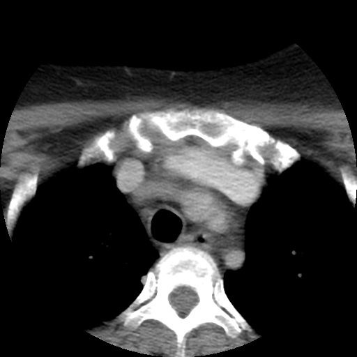 File:Carotid body tumor (paraganglioma) (Radiopaedia 38586-40729 A 33).jpg