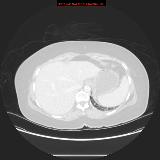 File:Carotid body tumor with lung metastases (Radiopaedia 9301-48390 Axial lung window 60).jpg